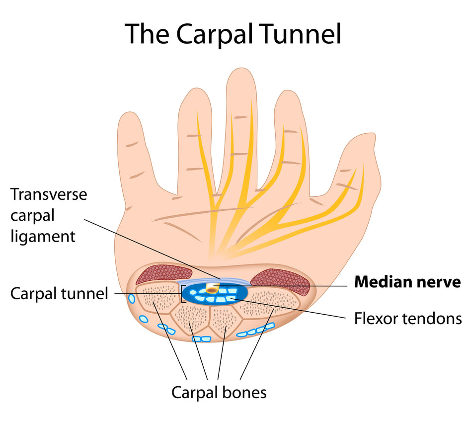 Carpal Tunnel Syndrome FAQ